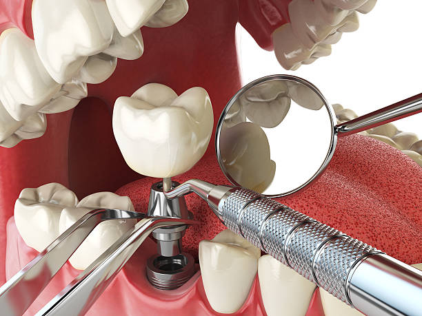 Best Emergency Treatment for Dental Infections or Abscesses in Anoka, MN